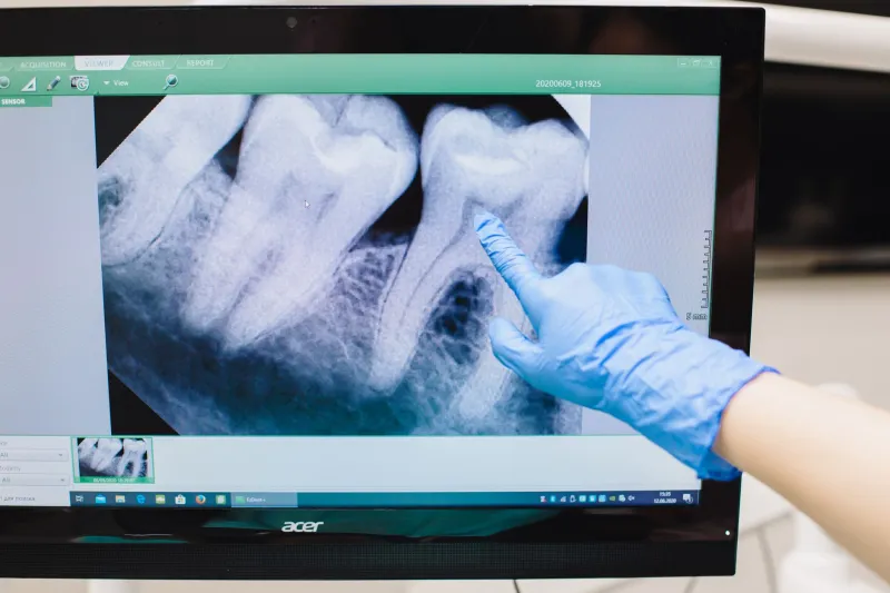 What a $150 Cavity Becomes When You Wait: The True Price of Delayed Dental Care
