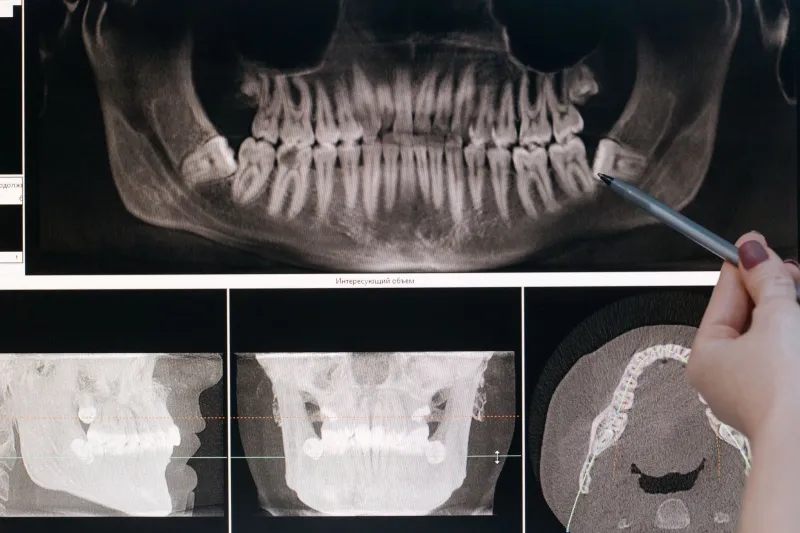 Out of Sight, Out of Mind — and Out of Time: What Your Wisdom Teeth Are Doing Behind the Scenes